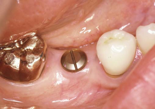 インプラント治療一覧 | 治療例紹介 | くわの歯科クリニック